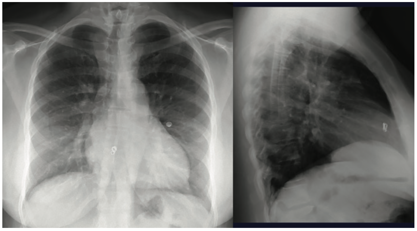 Coil Embolization to the Right Side of the Heart After Elective Hypogastric Vein Embolization
